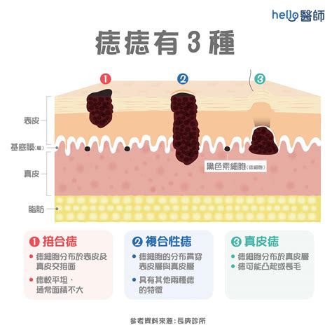 痣是怎麼形成的